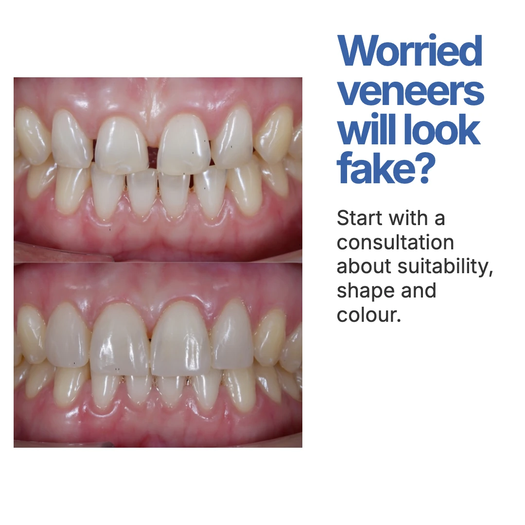 Worried veneers will look fake? ad creative